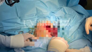 All'ospedale di Perugia intervento chirurgico di 6 ore per ernia diaframmatica su una bambina di 5 mesi 3