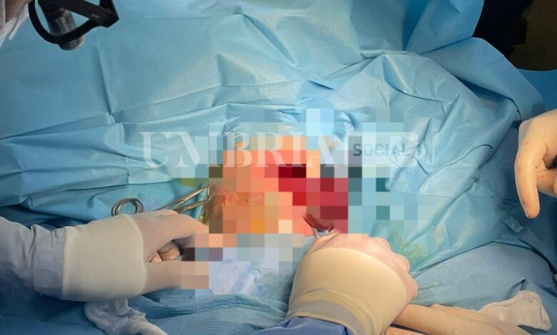 All'ospedale di Perugia intervento chirurgico di 6 ore per ernia diaframmatica su una bambina di 5 mesi 2 All'ospedale di Perugia intervento chirurgico di 6 ore per ernia diaframmatica su una bambina di 5 mesi 1