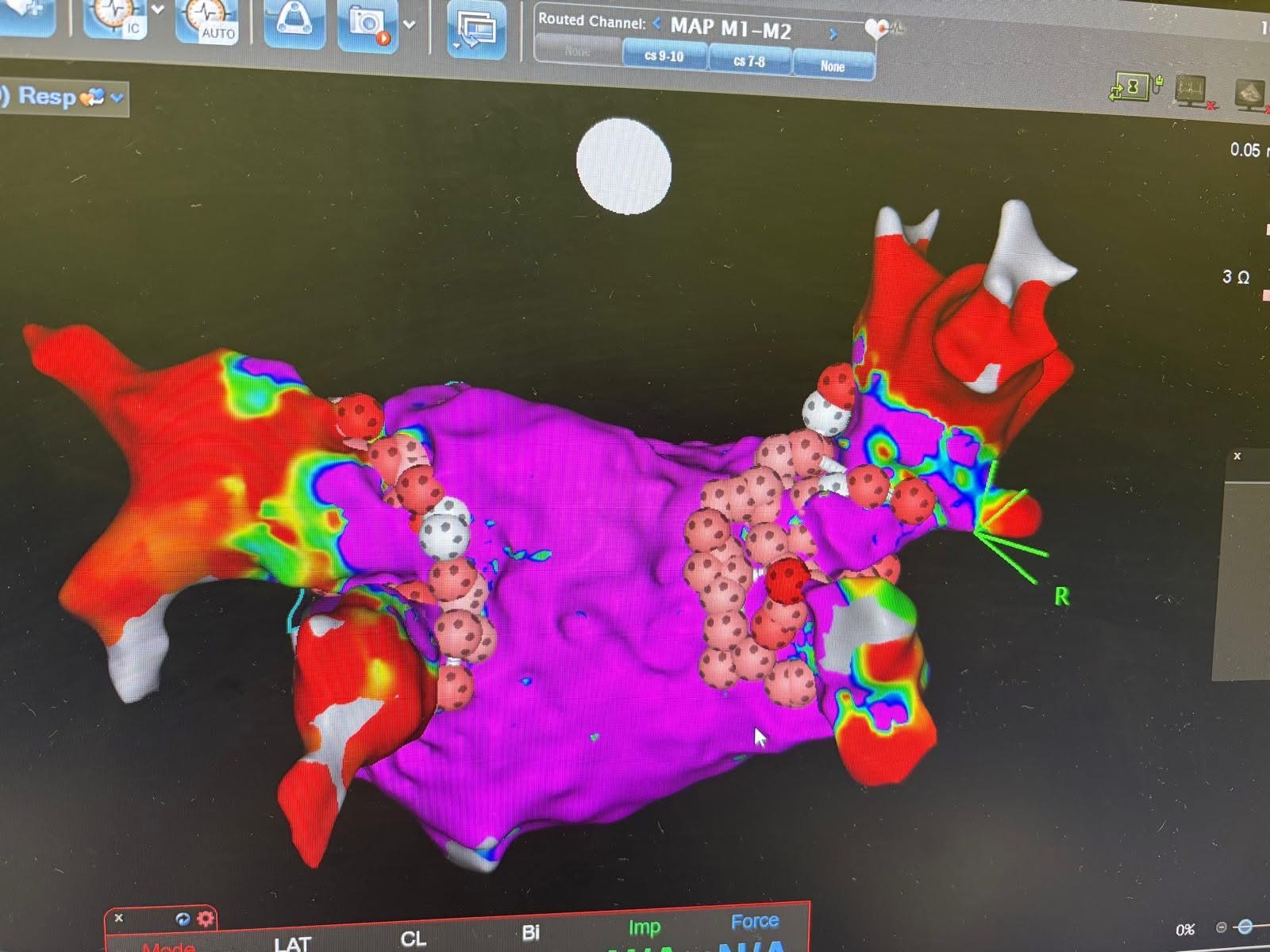 Ospedale di Perugia: avviata la cardioneuroablazione, tecnica mini invasiva innovativa 7